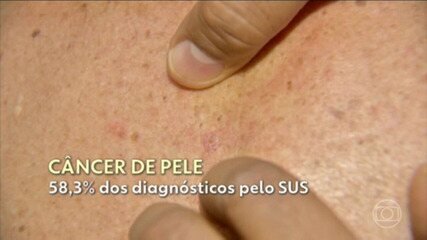Imagem de capa para Melanomas: entenda por que eles nem sempre são fáceis de identificar